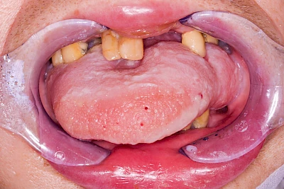 Beispiele: Einbiss & Bluterguss