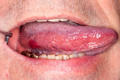 Beispiele: Einbiss & Bluterguss