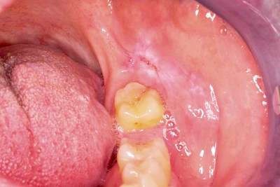 Beispiele: Einbiss & Bluterguss