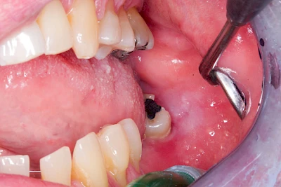 Beispiele: Einbiss & Bluterguss