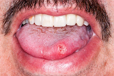 Beispiele: Einbiss & Bluterguss