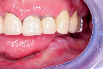 Beispiele: Einbiss & Bluterguss