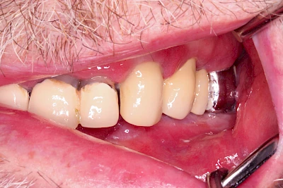 Beispiele: Einbiss & Bluterguss