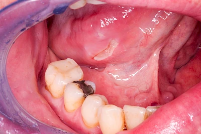 Beispiele: Einbiss & Bluterguss