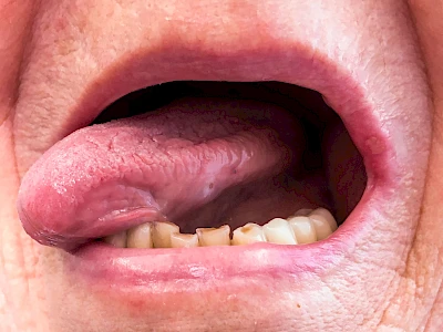 Beispiele: Einbiss & Bluterguss