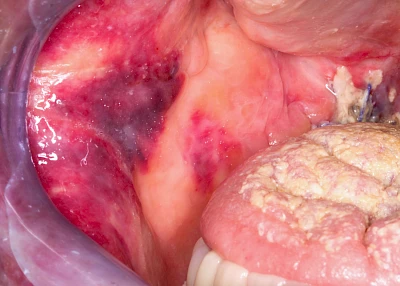 Beispiele: Einbiss & Bluterguss