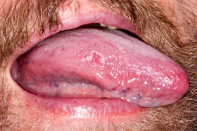 Beispiele: Einbiss & Bluterguss