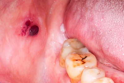 Beispiele: Einbiss & Bluterguss