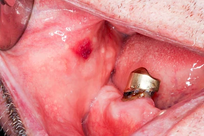 Beispiele: Einbiss & Bluterguss