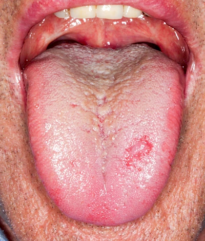 Beispiele: Einbiss & Bluterguss