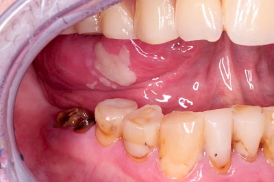 Beispiele: Einbiss & Bluterguss