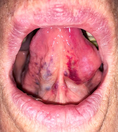 Beispiele: Einbiss & Bluterguss