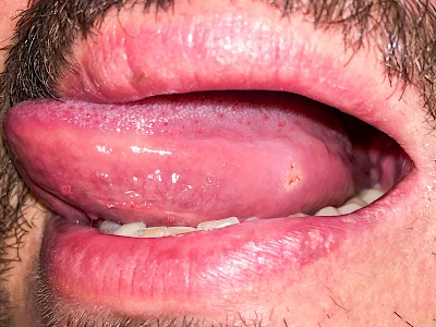 Beispiele: Einbiss & Bluterguss