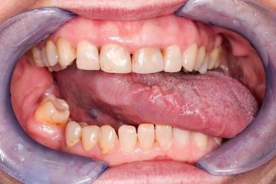 Beispiele: Einbiss & Bluterguss