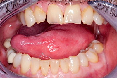 Beispiele: Einbiss & Bluterguss