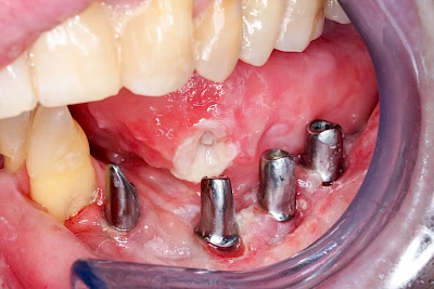 Beispiele: Einbiss & Bluterguss