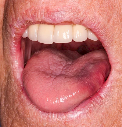 Beispiele: Einbiss & Bluterguss