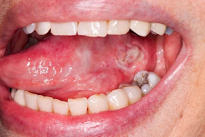 Beispiele: Einbiss & Bluterguss