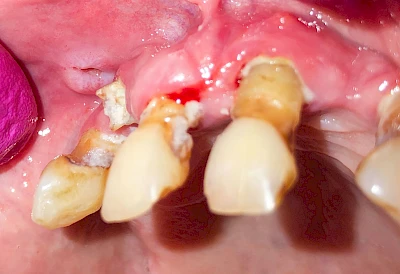 Beispiele: Einbiss & Bluterguss