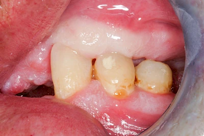 Beispiele: Einbiss & Bluterguss