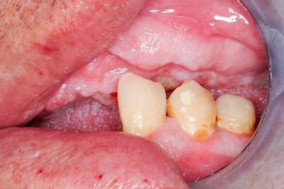 Beispiele: Einbiss & Bluterguss