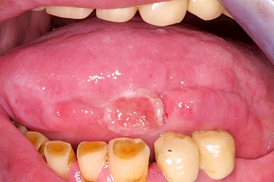 Beispiele: Einbiss & Bluterguss