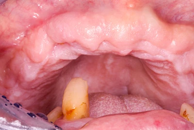 Beispiele: Einbiss & Bluterguss