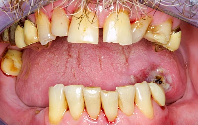 Beispiele: Einbiss & Bluterguss