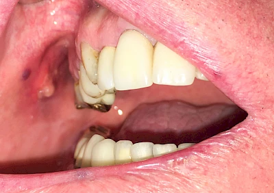 Beispiele: Einbiss & Bluterguss