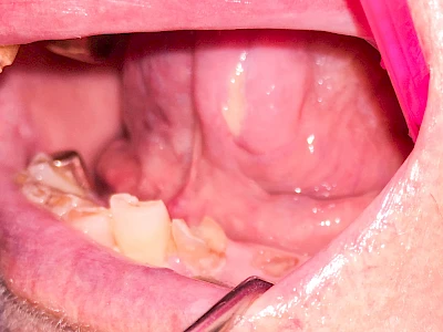 Beispiele: Einbiss & Bluterguss