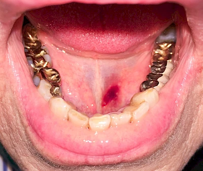 Beispiele: Einbiss & Bluterguss