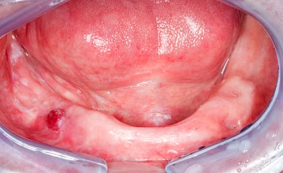 Beispiele: Einbiss & Bluterguss