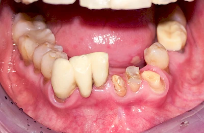 Beispiele: Einbiss & Bluterguss