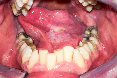 Beispiele: Einbiss & Bluterguss