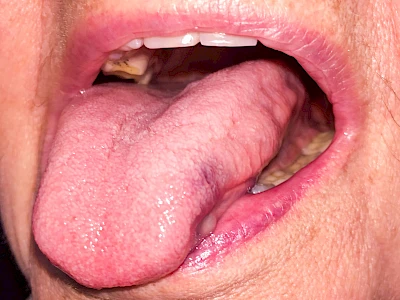 Beispiele: Einbiss & Bluterguss