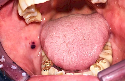 Beispiele: Einbiss & Bluterguss