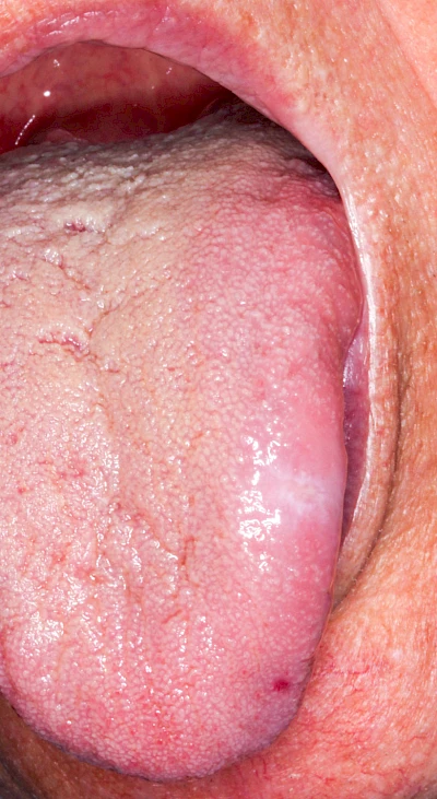 Beispiele: Einbiss & Bluterguss