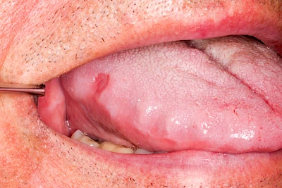 Beispiele: Einbiss & Bluterguss