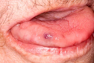 Beispiele: Einbiss & Bluterguss