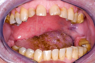 Beispiele: Blutpunkt, Blutblase & rote Flecken