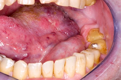 Beispiele: Blutpunkt, Blutblase & rote Flecken