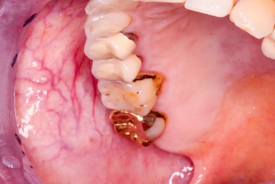 Beispiele: Blutpunkt, Blutblase & rote Flecken
