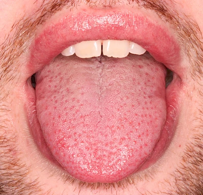 Beispiele: Blutpunkt, Blutblase & rote Flecken