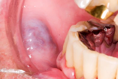 Beispiele: Blutpunkt, Blutblase & rote Flecken