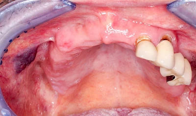 Beispiele: Blutpunkt, Blutblase & rote Flecken