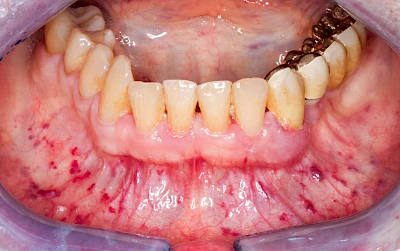 Beispiele: Blutpunkt, Blutblase & rote Flecken