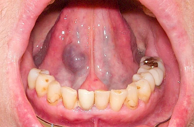 Beispiele: Blutpunkt, Blutblase & rote Flecken