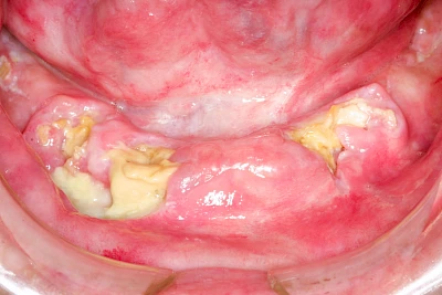 Beispiele: Wundheilungsstörung
