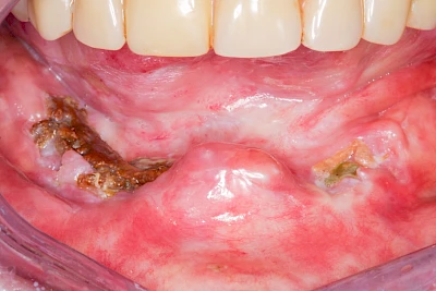 Beispiele: Wundheilungsstörung