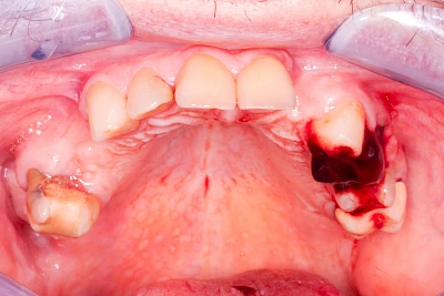 Beispiele: Wundheilungsstörung